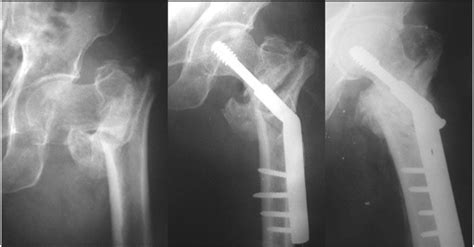Valgus Sliding Subtrochanteric Osteotomy For Neglected Fractures Of The