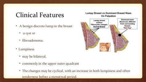 Benign Diseases Of Breast