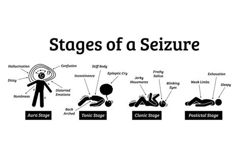 Stages And Phases Of A Seizure Aura Tonic Clonic Postictal 776003