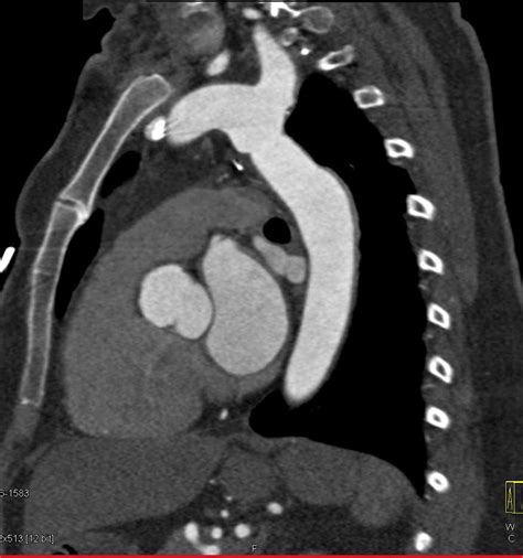 Changes Post Coarctation Of The Aorta Repair Cardiac Case Studies