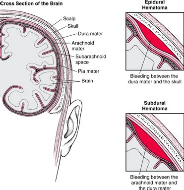 Intracranial hematomas can be epidural (above the epidural membrane), subdural (below the epidural membrane), intracerebral (within the brain tissue), or take injuries to the head seriously because of the risk of bleeding causing injuries like epidural, subdural, and intracerebral hemorrhage. PG Medic: Subdural/Extradural Hematoma