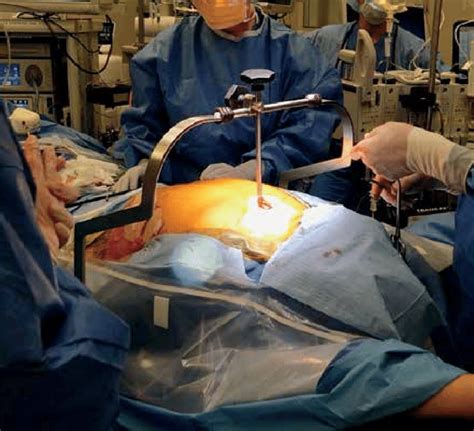 The Transcervical Thymectomy Operative Field After Placement Of The