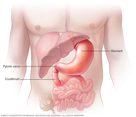 Stomach Polyps Disease Reference Guide