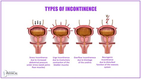 Explore The Symptom Causes And Treatments Of Urinary Incontinence Oklahoma Physical Therapy