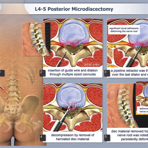 Laminectomies Microdiscectomy And Bilateral Micro Foraminotomie