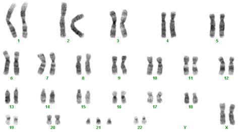 This male has a full chromosome complement plus an extra chromosome 21. Double Aneuploidy in Down Syndrome | IntechOpen