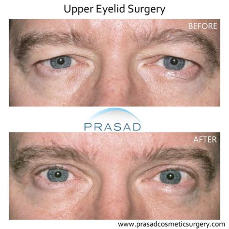 Can Plastic Surgery Fix Hooded Eyes Prasad Cosmetic Surgery