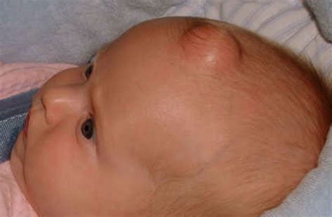Epidermoid Cyst Pictures Symptoms Causes Treatment Removal Healthmd