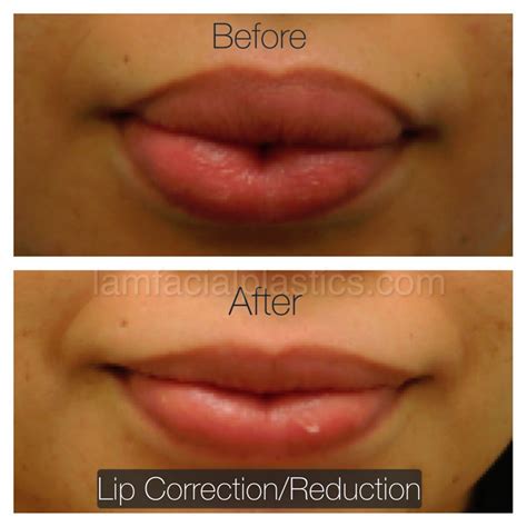 How Can I Reduce My Lips Size