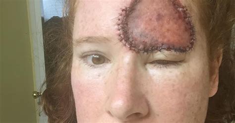 Symptoms Of Skin Cancer Womans Melanoma Looked Like Liver Spot