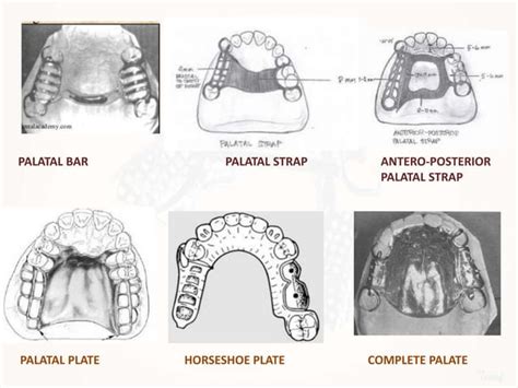 Designing A Removable Partial Denture Kennedys Classification