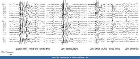 Epilepsy With Myoclonic Atonic Seizures Medlink Neurology
