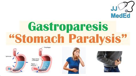 Gastroparesis Stomach Paralysis Causes And Risk Factors Signs