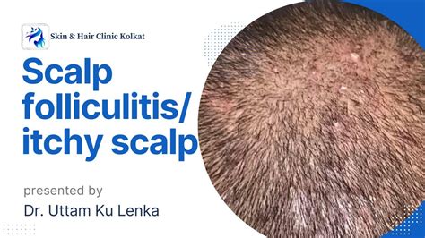 How To Manage Scalp Folliculitis With Pain And Itching By Mbbs Md