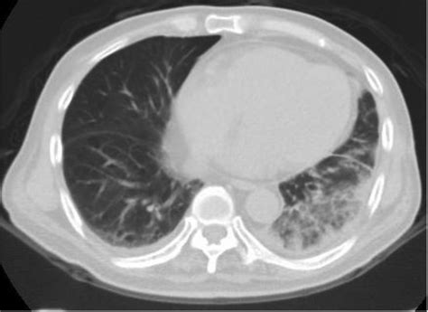 Initial Chest Computed Tomography Ct Left Lower Lung Air Bronchial