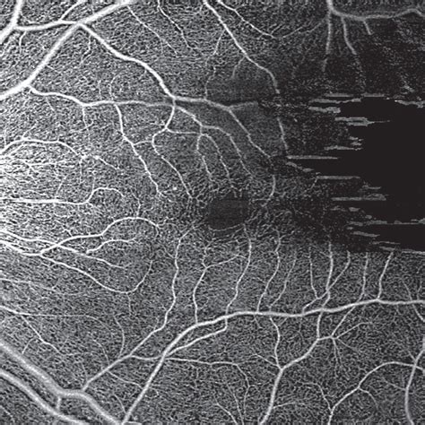 Oct Angiography Artifacts Clinical Tree