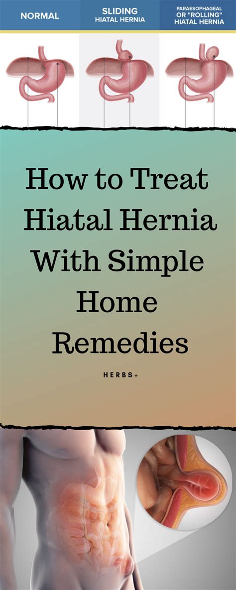 How To Treat Hiatal Hernia With Simple Home Remedies Natural