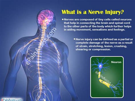 What Is Nerve Injurytypestreatmentcausessymptomsrisk Factorsdiagnosis