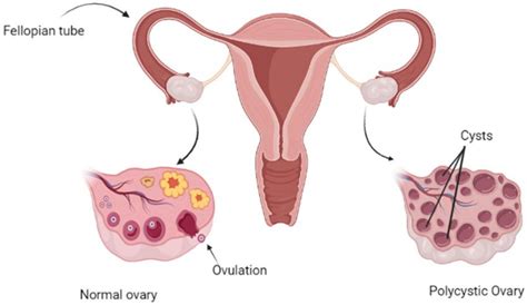 Biomedicines Free Full Text Polycystic Ovarian Syndrome A Complex Disease With A Genetics