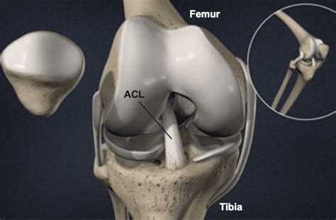 Anterior Cruciate Ligament Acl Tear Symptoms Prevention And More