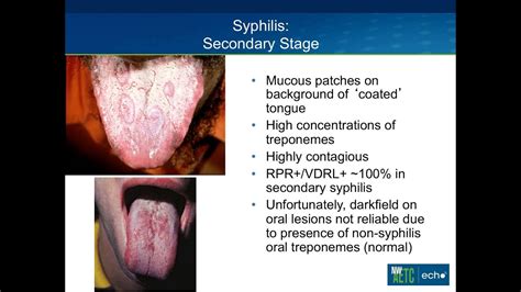 Presentation And Management Of Syphilis In The Setting Of Hiv Youtube