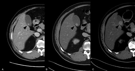 Computed Tomography Shows Growth Of The Gallbladder Polyp Arrowhead