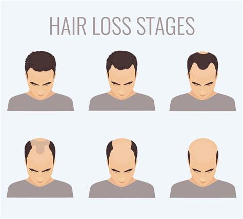 Woman With Different Stages Of Hair Loss Vegas Valley Hair Restoration