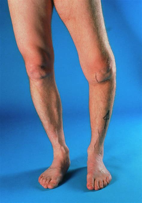 Severe Osteoarthritis In The Left Knee Photograph By Medical Photo Nhs Lothianscience Photo