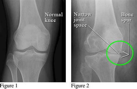 Bone Spur Osteophytes Causes Signs Symptoms And Treatment