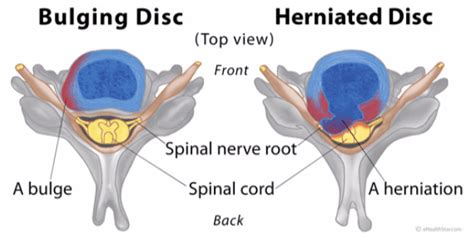 Bulging Discs Symptoms And Treatment