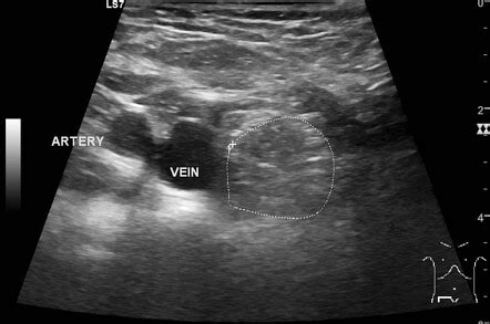 Femoral Hernia Radiology Case Radiopaedia Org