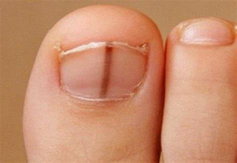 Why Do I Have A Vertical Line On My Toenail Design Talk