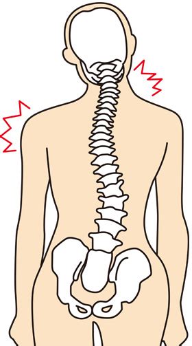 側弯症による肩こり、腰痛、背中の痛みを解消することはできる？ オーラウェーブ療術院