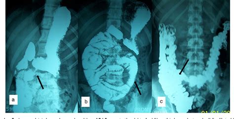 Figure 1 From Intestinal Obstruction Due To Malrotation Of Midgut And