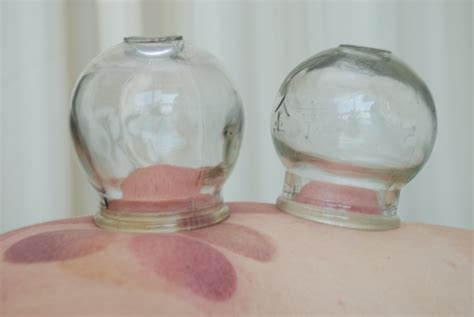 Cupping Therapy Dr Xie In Lake County Libertyville Dr Xies Lake County Libertyville