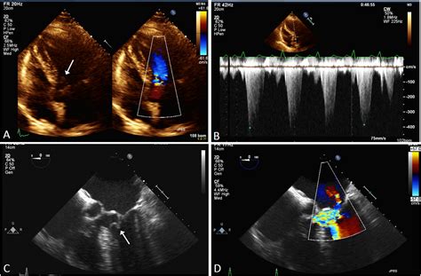 Dynamic Left Ventricular Outflow Tract Obstruction Causing Myocardial