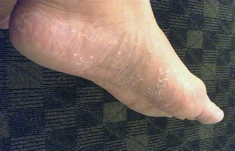 Peeling Skin On Bottom Of Feet Child Rashes And Spots In Children