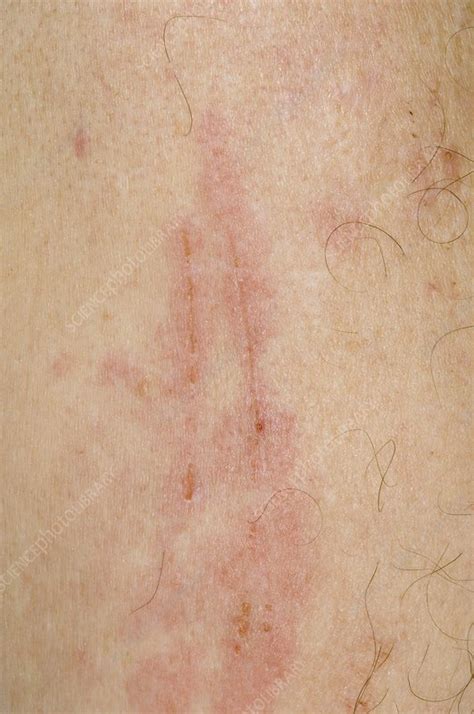 Scratch Marks On Arm In Eczema Stock Image C0083611 Science