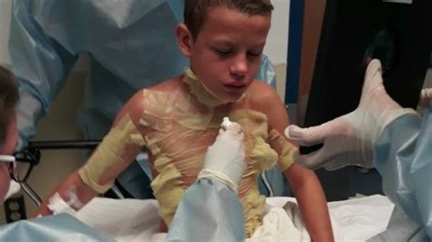 Boy Suffers Second Degree Burns In ‘fire Challenge Boston News