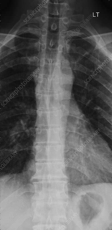 Sternal Angle T4 5 X Ray Stock Image C0366435 Science Photo Library