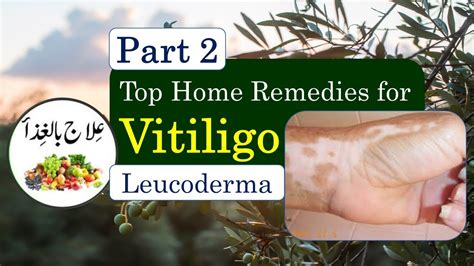 Top Home Remedies For Vitiligo Leucoderma White Skin Patches Youtube
