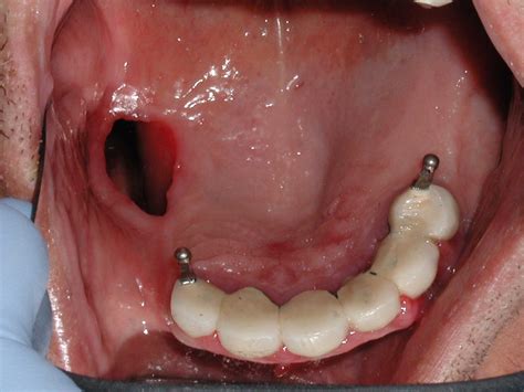 Oral Squamous Cell Carcinoma Survivor Dr Caputo Palm Harbor Dentist
