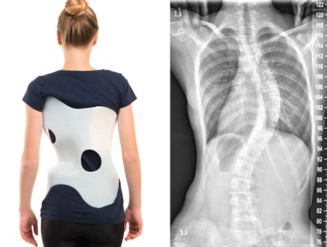 scoliosis a curved spine and the treatment options brandon orthopedics