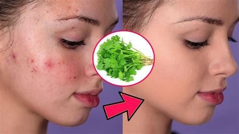 How To Remove Pimples Overnight Acne Treatment Home Remedy For