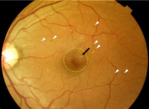 Figure 2 Fundus Photograph Of A Person Webvision Ncbi Bookshelf