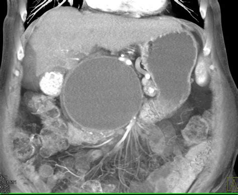 Large Pseudocyst In Patient With Chronic Pancreatitis Pancreas Case