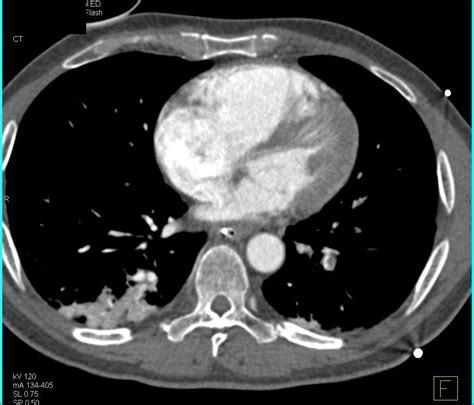 Multiple Bilateral Pulmonary Embolism Chest Case Studies Ctisus Ct