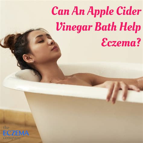 Can An Apple Cider Vinegar Bath Help Eczema Stop Bathing In Bleach