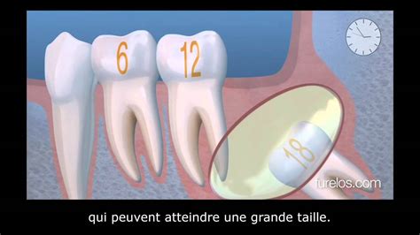 Les troisièmes molaires ou dents de sagesse YouTube