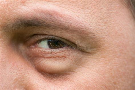 Eyesore Inflammation Or Bag Swelling Under Eye Stock Photo Image Of